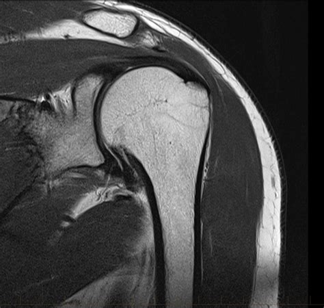 shoulder mri rotator cuff tear